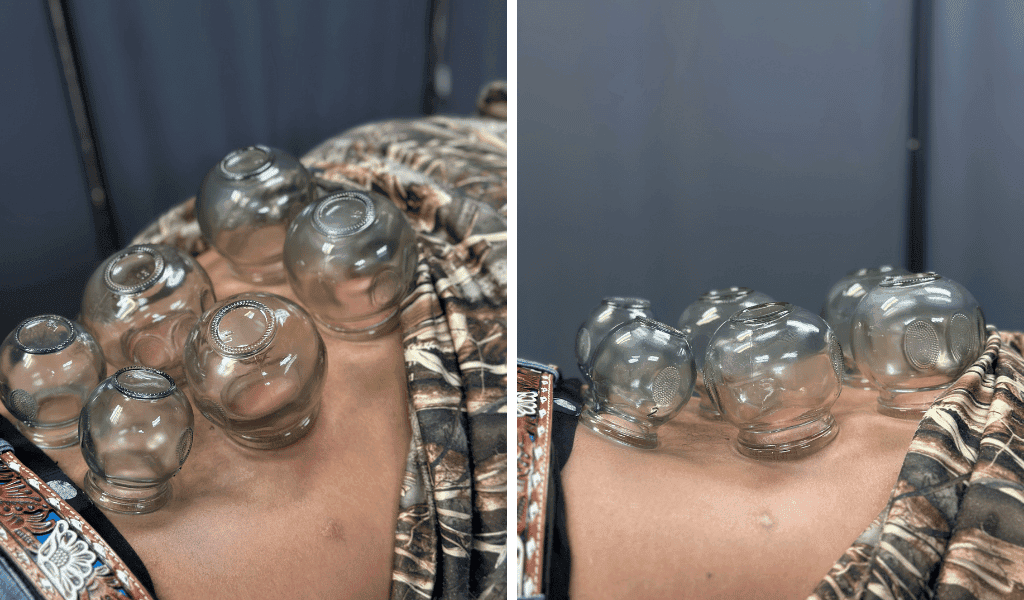 Fire Cupping | Top-Rated Chiropractor In Lubbock, Tx June 15, 2026 Fire cupping in lubbock tx